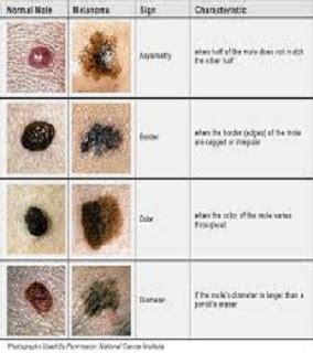 How To Remove A Mole: Warts, Moles and Skin Tags - Can They Develop ...