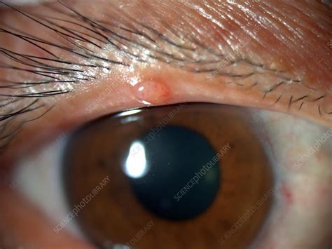 Conjunctival Cyst - Stock Image - C027/1495 - Science Photo Library