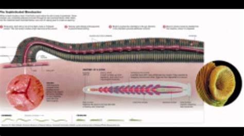 Leech Therapy P 1 - YouTube