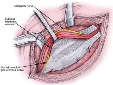 Open Inguinal Hernia Repair Technique: Approach Considerations ...