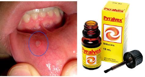 Pyralvex sirve para quitar las llagas, úlceras, de la boca. (Muguet, afta, candidiasis oral ...