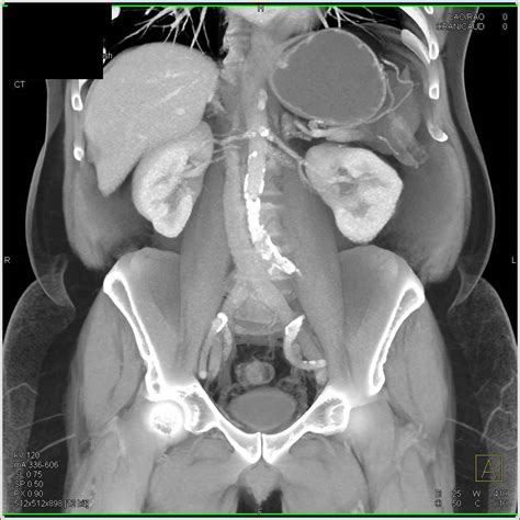 Carcinoma at Gastroesophageal (GE) Junction - Stomach Case Studies ...