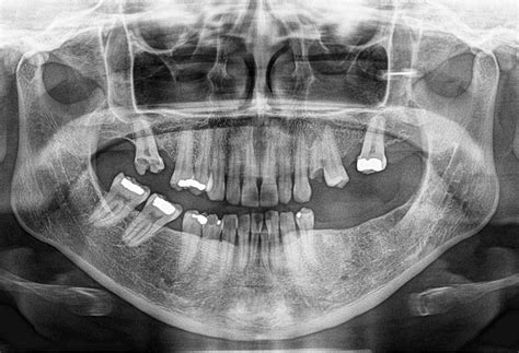 Torus mandibular – Dento Metric | Radiología Dental, Oral y Maxilofacial