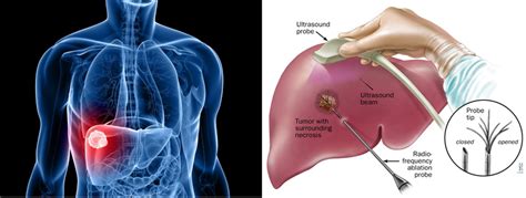 Liver Cancer Map