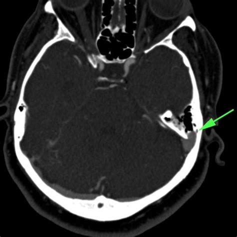 Sigmoid sinus diverticulum, dehiscence, bilateral transverse sinus ...