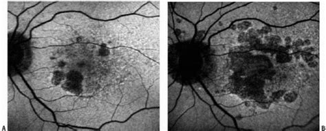 Lipofuscin of the Retinal Pigment Epithelium | Ento Key