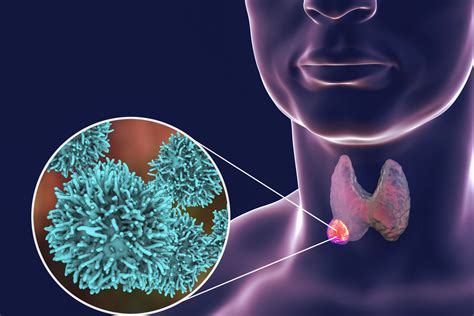 Estos dos síntomas poco conocidos pueden indicar cáncer de tiroides