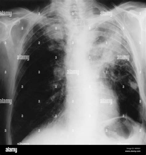 Silicosis x ray hi-res stock photography and images - Alamy