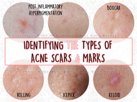 Understanding The Types Of Acne Scars — Post Inflammatory ...