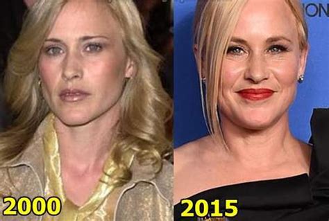 Patricia Arquette Plastic Surgery Before and After Photos