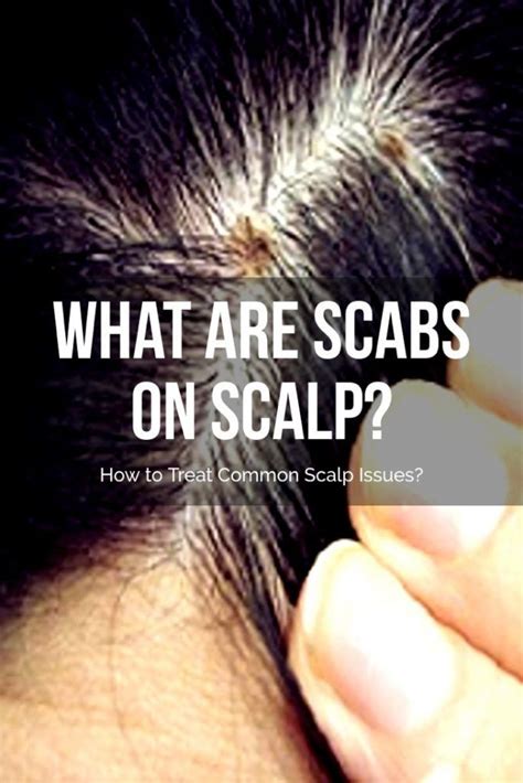 Scabs on scalp | Thick hair remedies, Dry scalp remedy, Scalp scabs