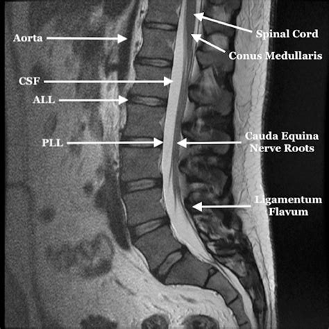 Spinal Cord Anatomy Cauda Equina