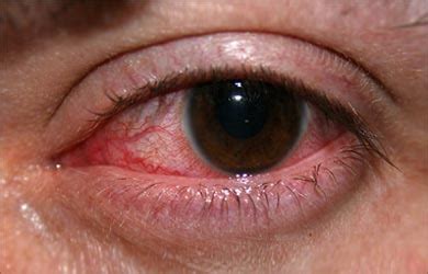 Causes and Symptoms of Eye Infections | Ocular Infections