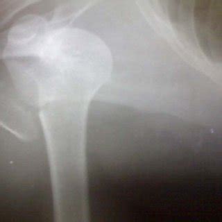 Case 1, X-ray showing fractured coracoid process and undisplaced... | Download Scientific Diagram