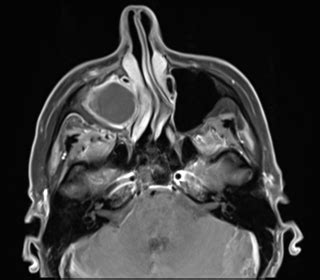 Maxillary sinus mucocele | Image | Radiopaedia.org