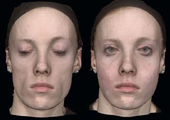 Lipodystrophy, Syndrome, Treatment, Symptoms