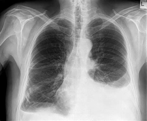 Pleural Effusion | Chest X-Ray - MedSchool