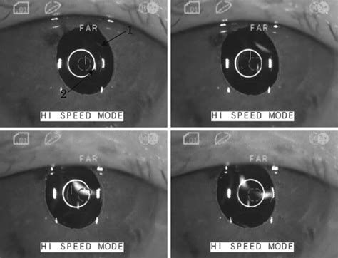 Visual Outcomes and Accommodative Response of the Lumina Accommodative ...