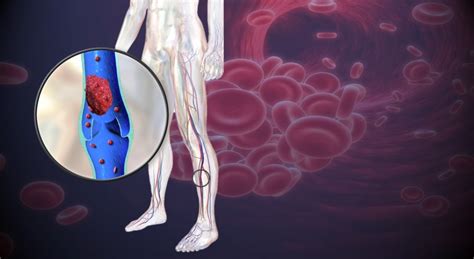 Symptoms of Blood Clot in Leg • MyHeart