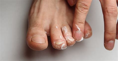 Best Ways to Prevent (and Treat) Athlete's Foot Fungus at Home - This Dad Does