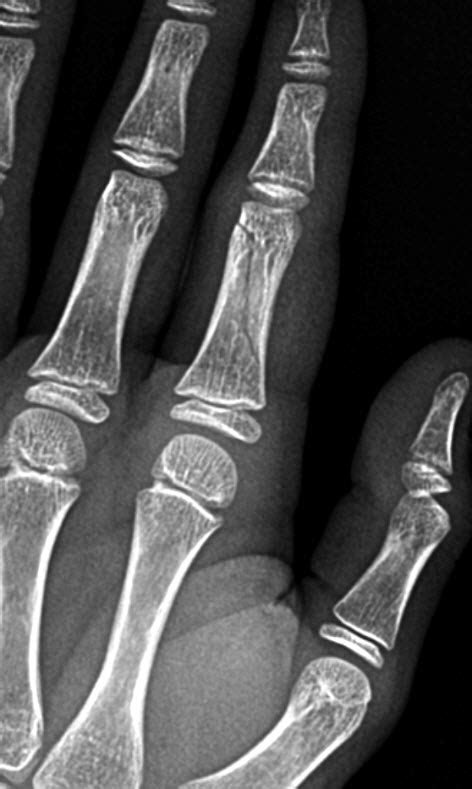 Thumb Proximal Phalanx Fracture