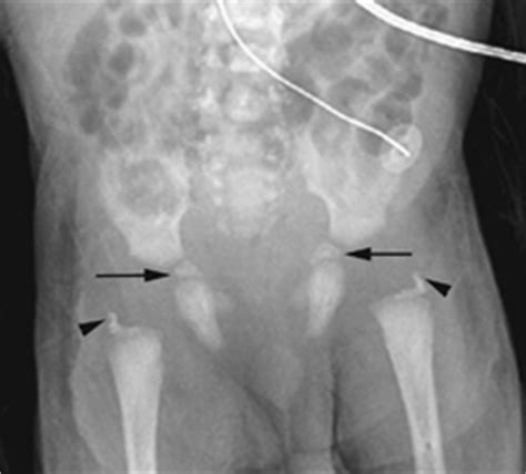 117 Chondrodysplasia Punctata | Radiology Key