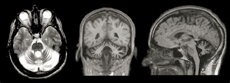 Cerebellar Degeneration