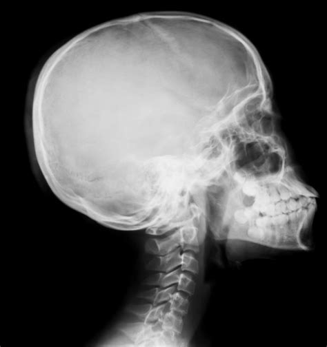 Skull Xrays Lateral View Buyxraysonline | My XXX Hot Girl