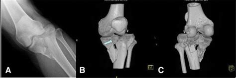 Schatzker Fracture Treatment | Schatzker Fracture Surgery