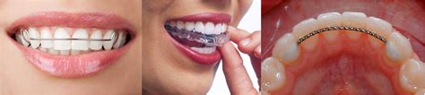 Which Type of Retainer Is Best for You?