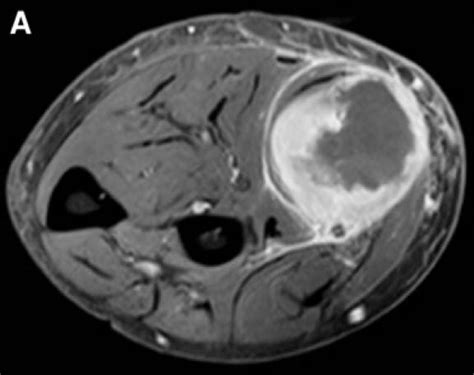 Soft Tissue Sarcoma - Pathology - Orthobullets