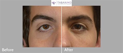 Almond Eye Surgery Before and After Gallery | Taban MD