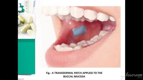 Buccal Drug Delivery System- BDDS - YouTube