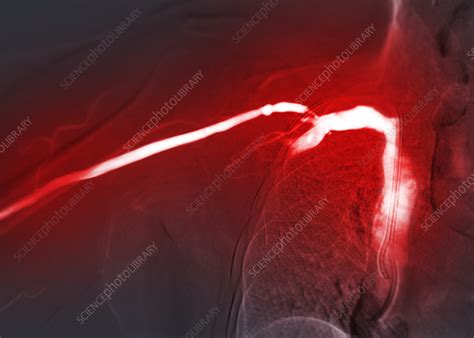 Treatment for blocked arteries, angiogram - Stock Image - F037/7242 ...