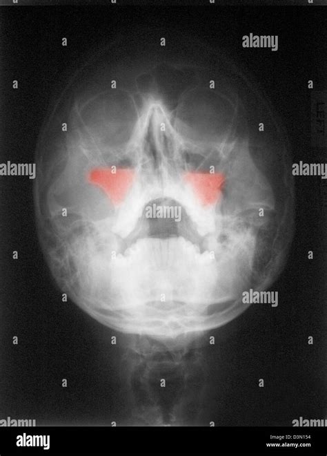 Sinus ct scan hi-res stock photography and images - Alamy