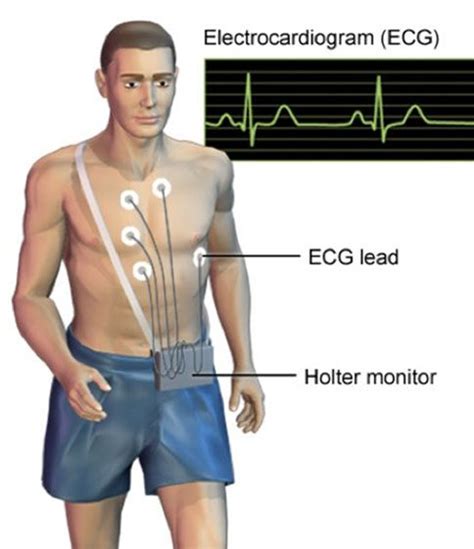 24 Hour Holter monitor - North Side Cardiology