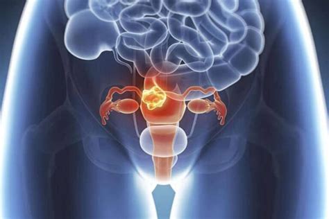 Endometrial Cancer: Symptoms, Risks, and Treatments