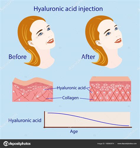 Hyaluronic acid injection, before and affect , vector illustration, diagram — Stock Vector ...