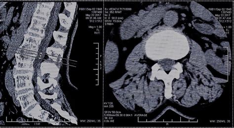 Ct Scan Spine