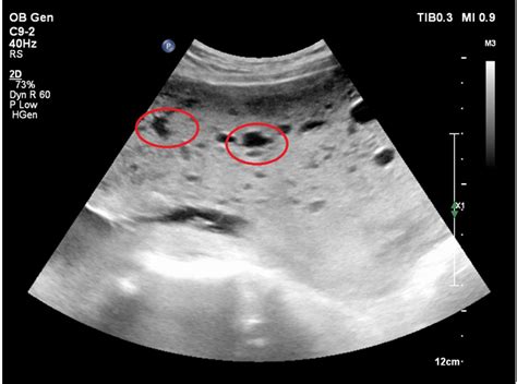 Molar pregnancy – case presentation of 23-year old pregnant women with ...