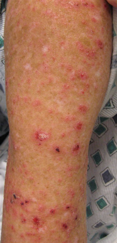 Lupus Rash On Legs Lupus Rash On Legs And Arms Pictur - vrogue.co