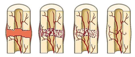 Were You Discharged from the Hospital with an Untreated Fracture? - The Thistle Law Firm