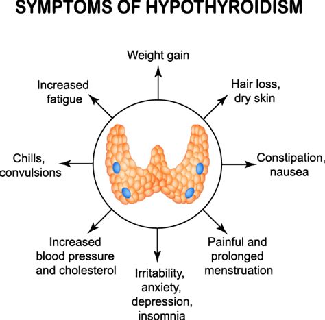 Hypothyroidism (Underactive Thyroid) Symptoms, Diagnosis, and Treatment ...