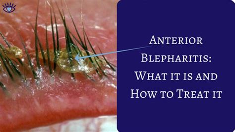 Anterior Blepharitis Causes, Symptoms, and Treatment - Eye Love