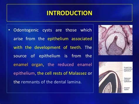 Odontogenic cysts