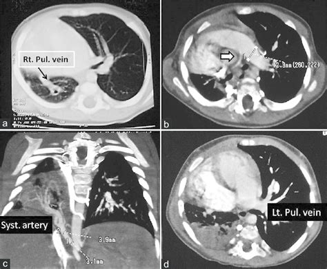 (a) Chest CT shows hypoplasia of the right lung, mediastinal shift and ...