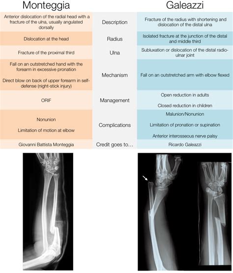 Musculoskeletal Emergency Medicine: Forearm Fractures