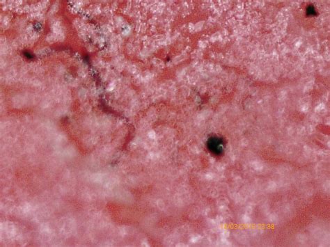 Morgellons Disease: Is It Real, Or Just Really Crazy? | Thought Catalog