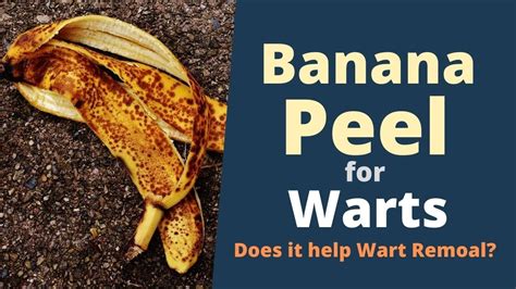 Banana Peel for Warts - How to Use Banana Peel to Remove Warts? - YouTube