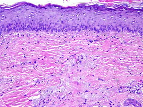 Actinic Keratosis Histology